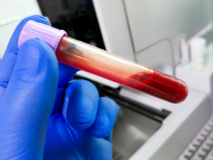 Blood Type A Linked to Higher Risk of Early Stroke, Research Shows