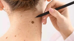 Could These Subtle Changes Be Early Signs of Melanoma? Don't Ignore These Hidden Skin Cancer Risks
