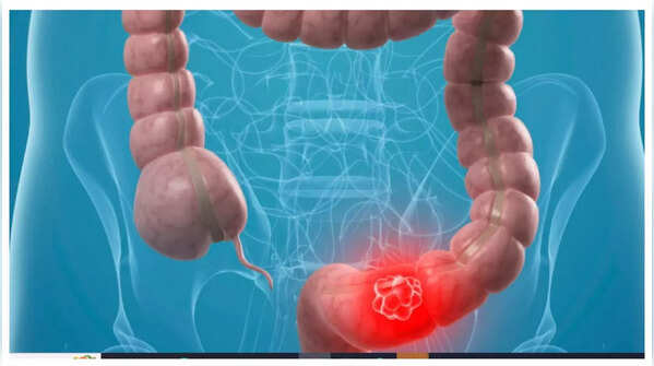 A person experiencing abdominal pain, a potential sign of colon cancer
