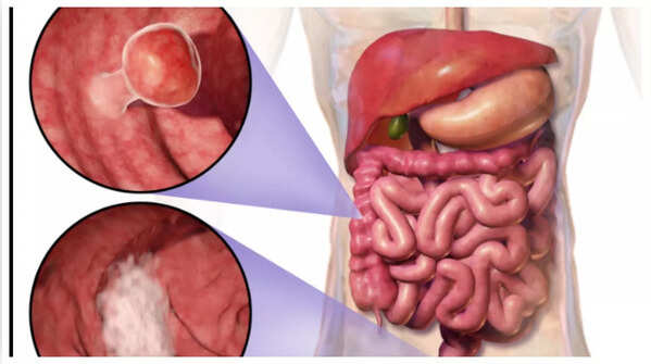 Visual representation of blood in stool, highlighting the importance of seeking medical advice